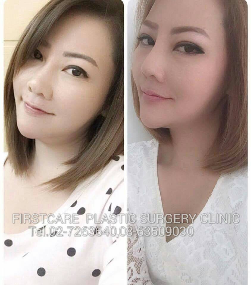 112015 nose job fixed