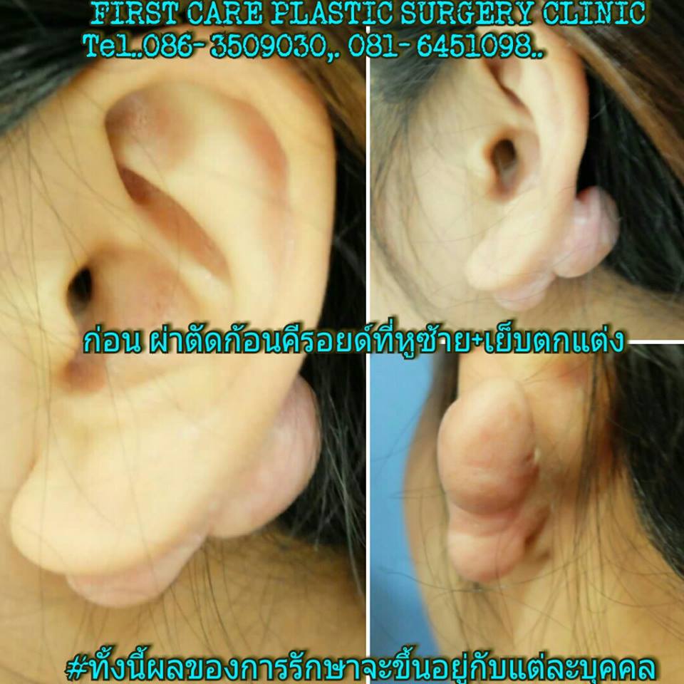 ear keroid (1).jpg