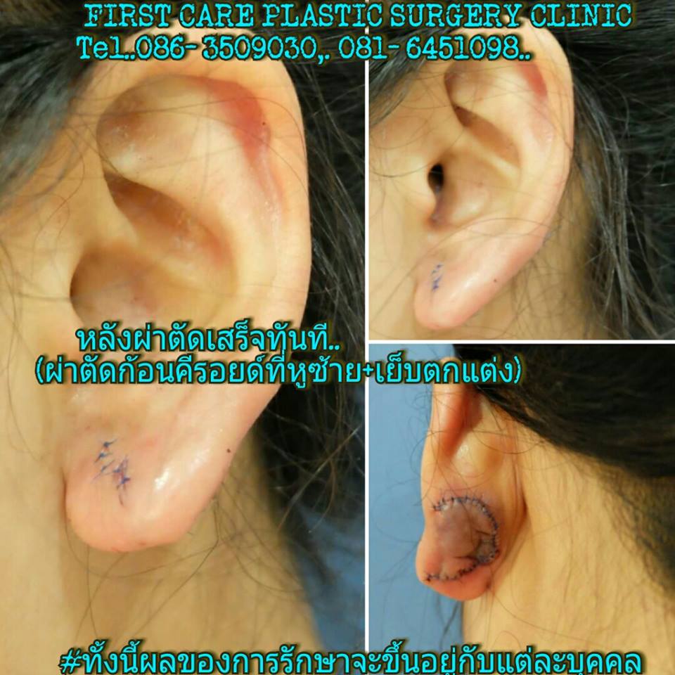 ear keroid (2).jpg