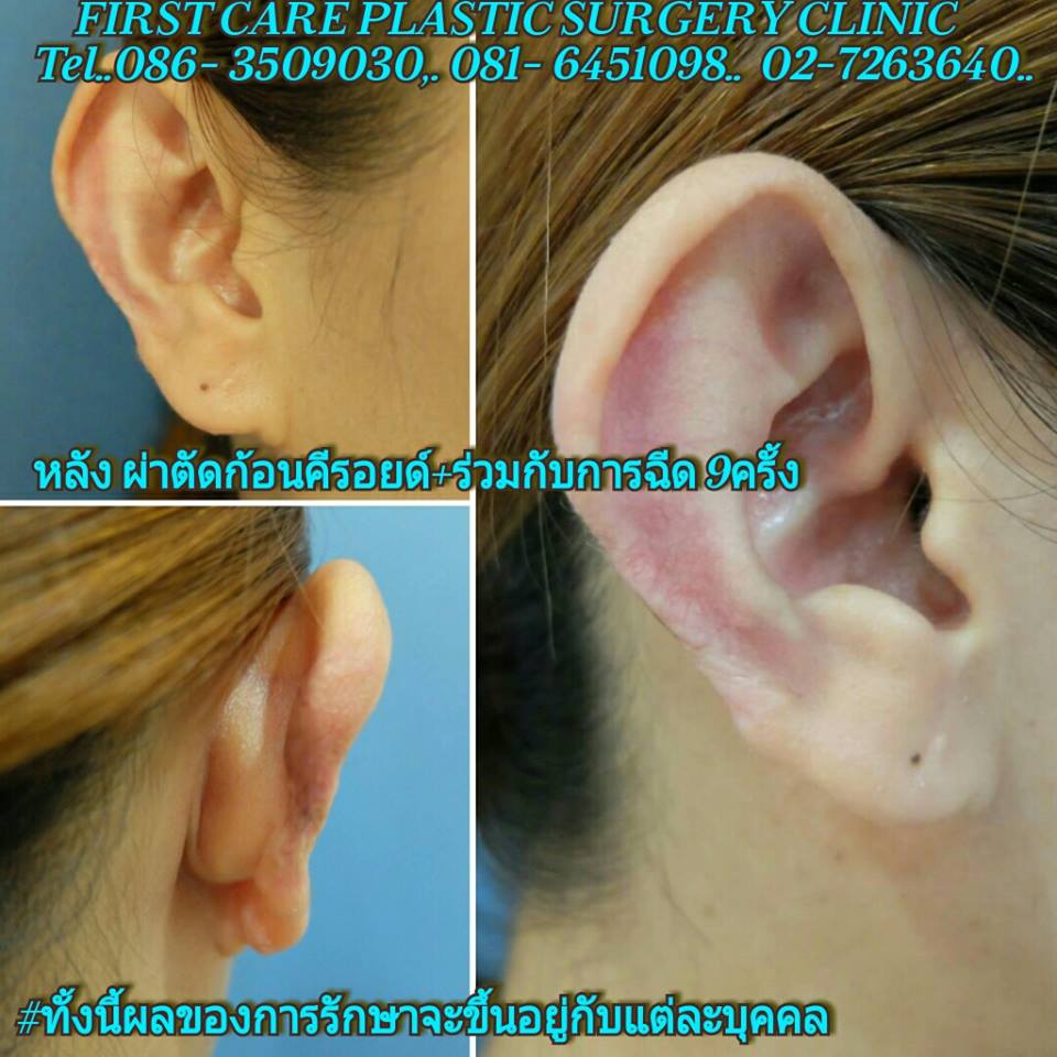 ear keroid (3).jpg