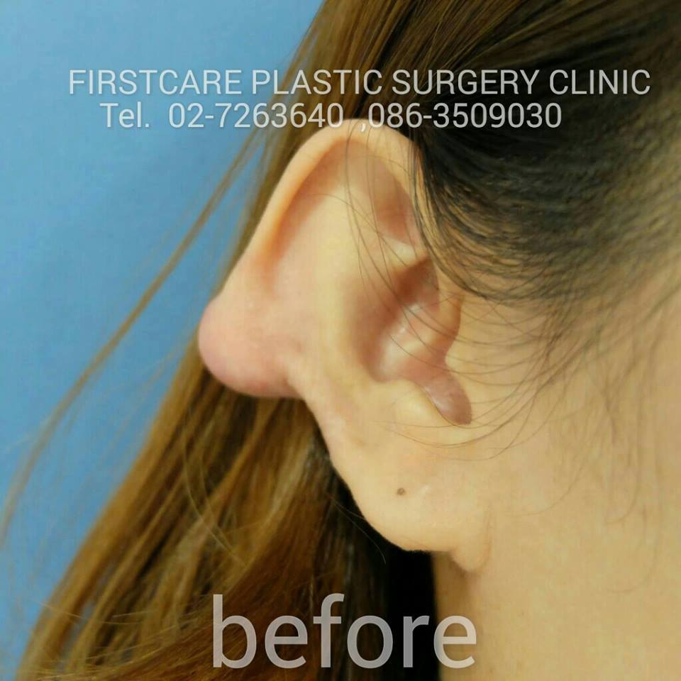 ear keroid (4).jpg