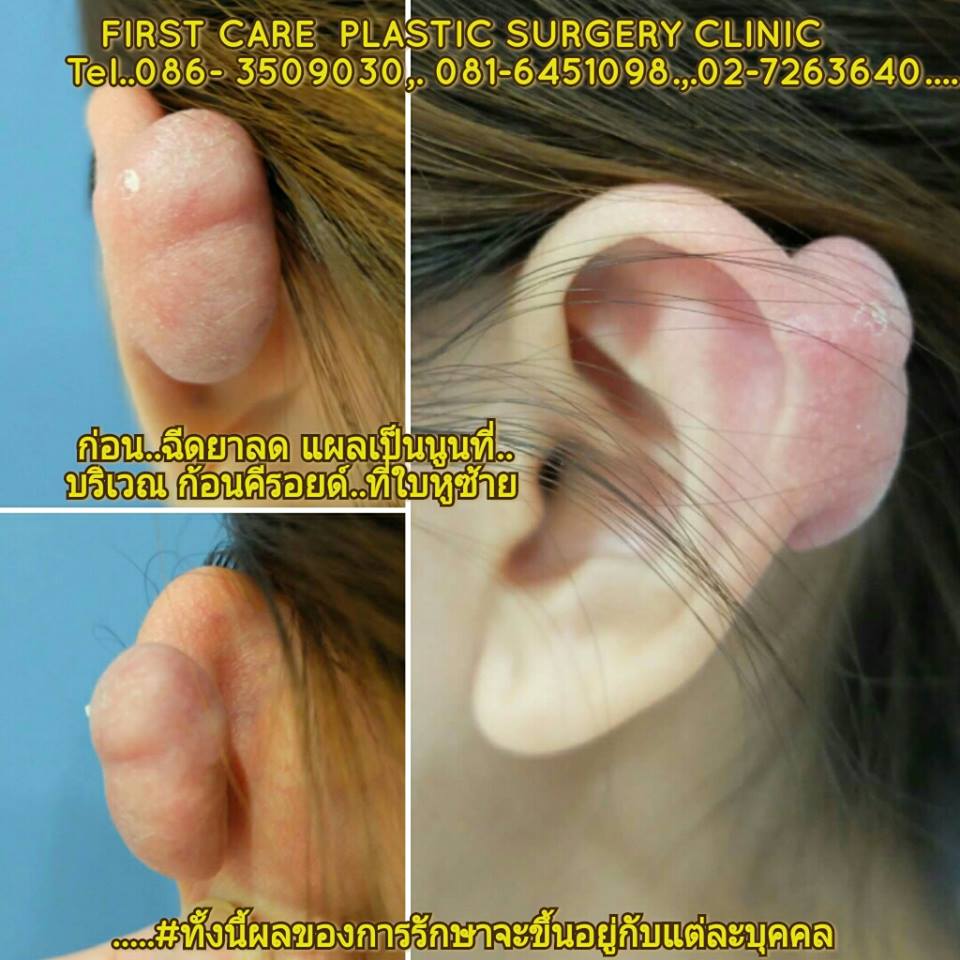 ear keroide (2).jpg