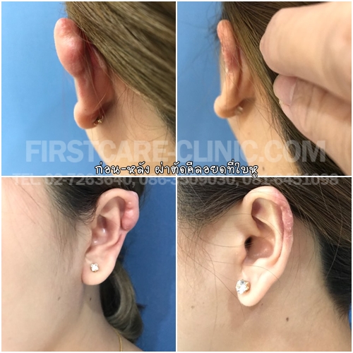 ear.scar2018.jpg
