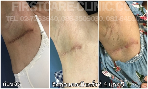 inject.scar.armpit 200218.jpg