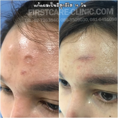 HN61-0073 14 d scar.jpg