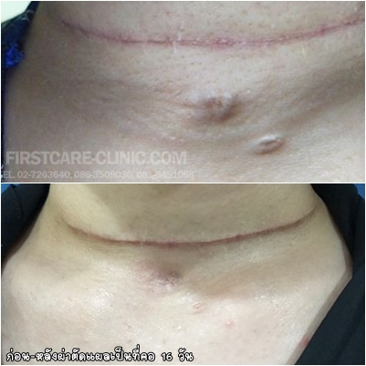 HN61-0100 neck scar.jpg