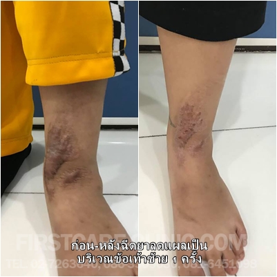 leg-scar.jpg