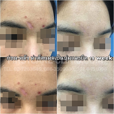610219scar.jpg