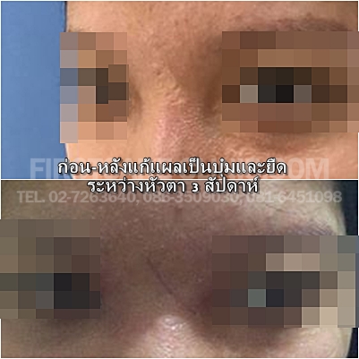 scar.jpg