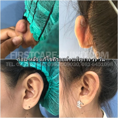 060119earkeroid.jpg