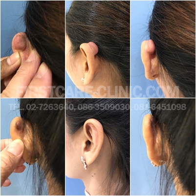 ear-keroide.jpg