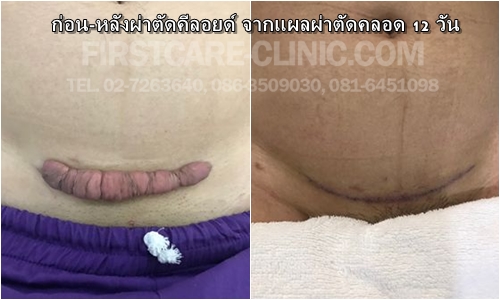 bellyscar.jpg