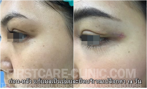 eyesugery.jpg