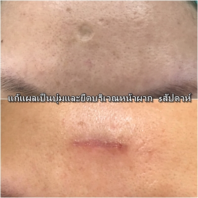 220619-forehead-scar.jpg
