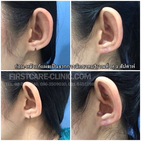 left-ear.jpg
