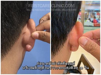 ear-right-19d.jpg