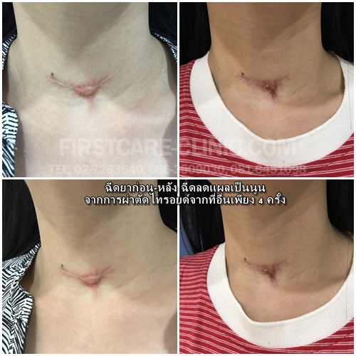 neck keroid-tiroid.jpg