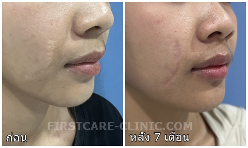 170869 right cheek both.jpg