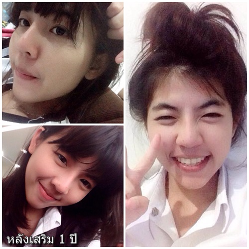 nosejob 1 y.jpg