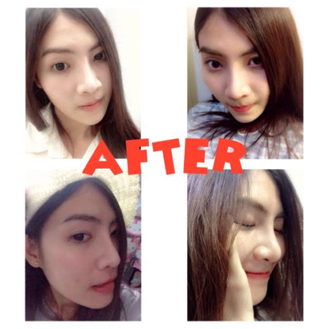 nosejob 1 w_2.jpg