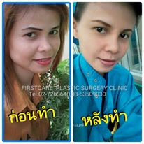 nosejob3w.jpg