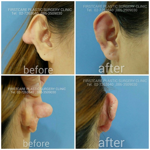 ear keroid.jpg